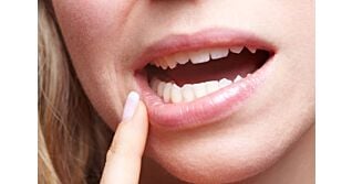 Afte in Bocca: Cause, Sintomi e Trattamenti Efficaci